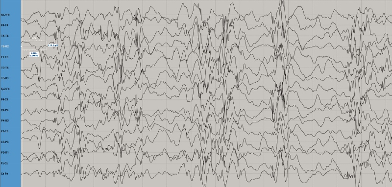 Badanie EEG u dzieci jest wykonywane najnowocześniejszym aparatem
