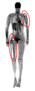 Obraz PET CT pacjentki z dwiema endoprotezamipng